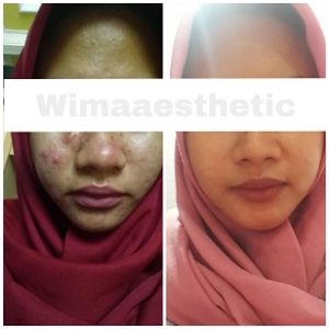 testimoni ACNE TREATMENT DI PEMALANG 1