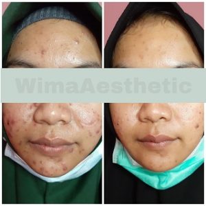 testimoni ACNE TREATMENT DI PEMALANG 1