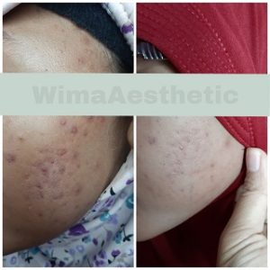 testimoni ACNE TREATMENT DI PEMALANG 1