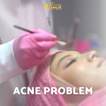 Acne Skin Solution - Wima Aesthetic
