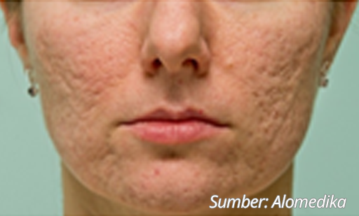 Scar Acne Atrofi