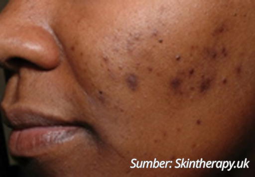 Scar Acne Hiperpigmentasi
