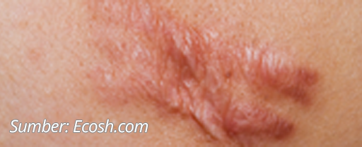 Scar Acne Hipertrofi