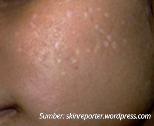 Scar Acne Hipopigmentasi