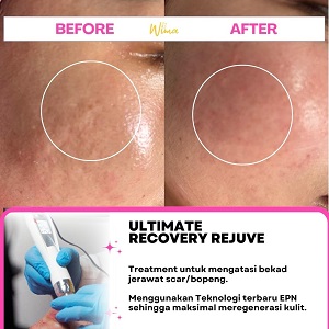 PENTING MANA SIH SKINCARE ATAU TREATMENT?